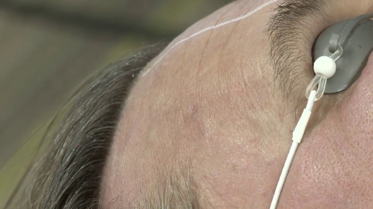 Fractional Skin Resurfacing with Ellipse Frax 1550: Part 6