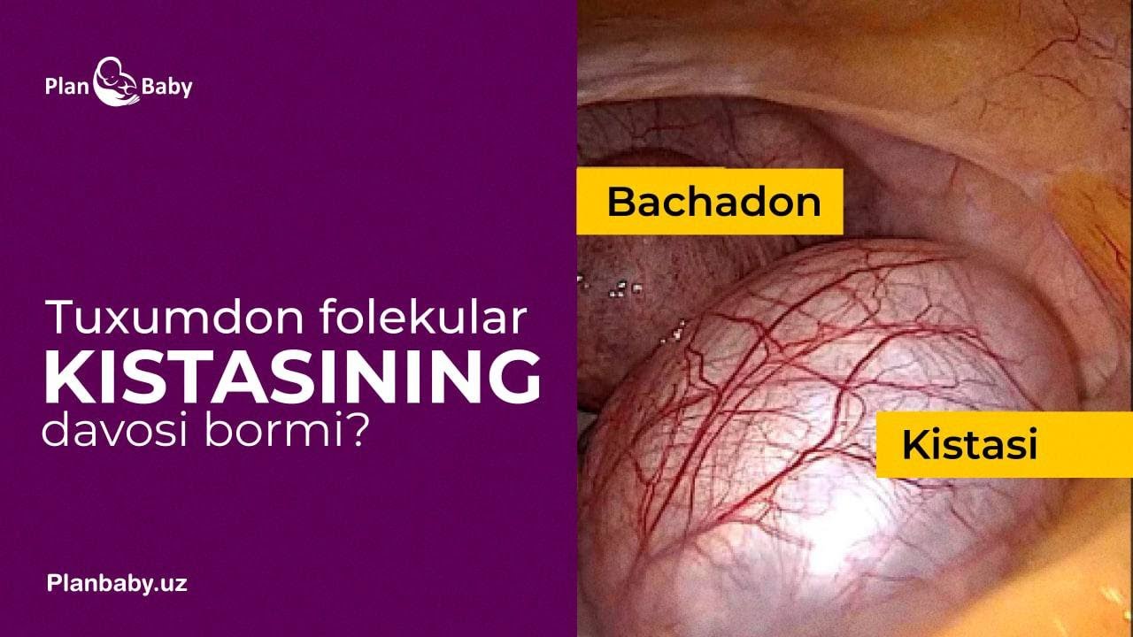Tuxumdon folekular kistasi: kelib chiqish sabablari nimada? #Sperolin #Mammolin #Salomatlikmarkazi