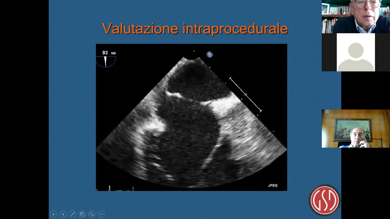 Il difetto interatriale: diagnosi strumentale - Carmelo Arcidiacono