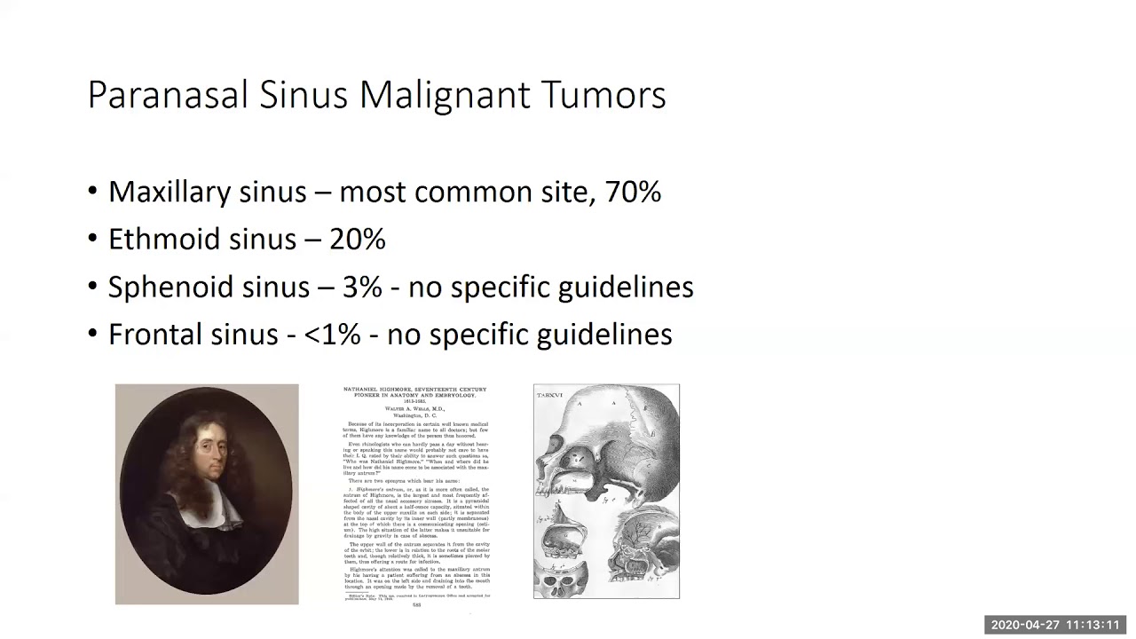 Malignant Tumors of the Paranasal Sinuses - Dr. Nadir Ahmad