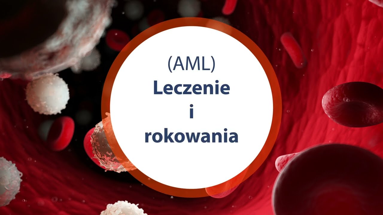 Ostra Białaczka Szpikowa AML -  leczenie i rokowania Sanitas