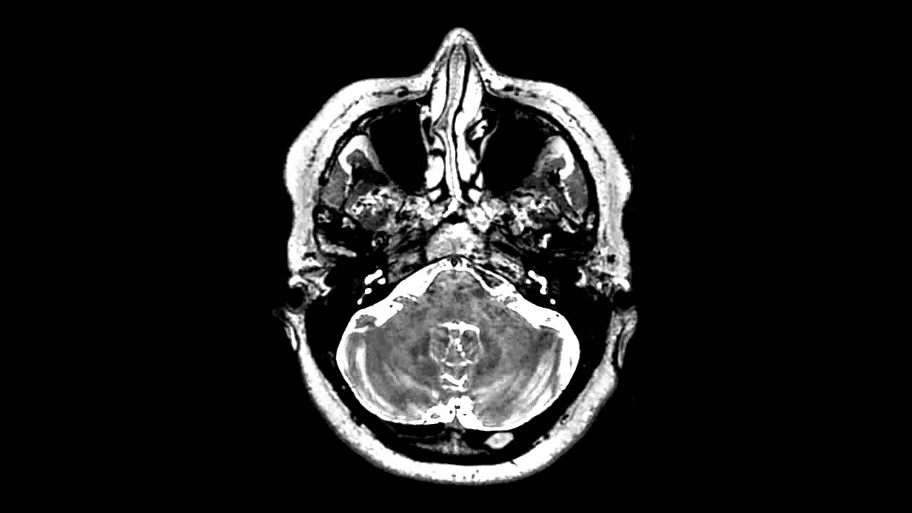 3D T2 brain MRI imaging