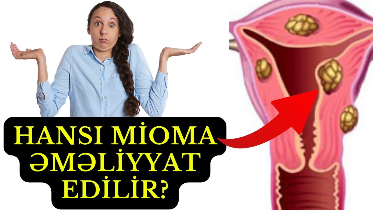 Qadın orqanında MİOMA d&uuml;y&uuml;nləri- Nə vaxt əməliyyat edilir?