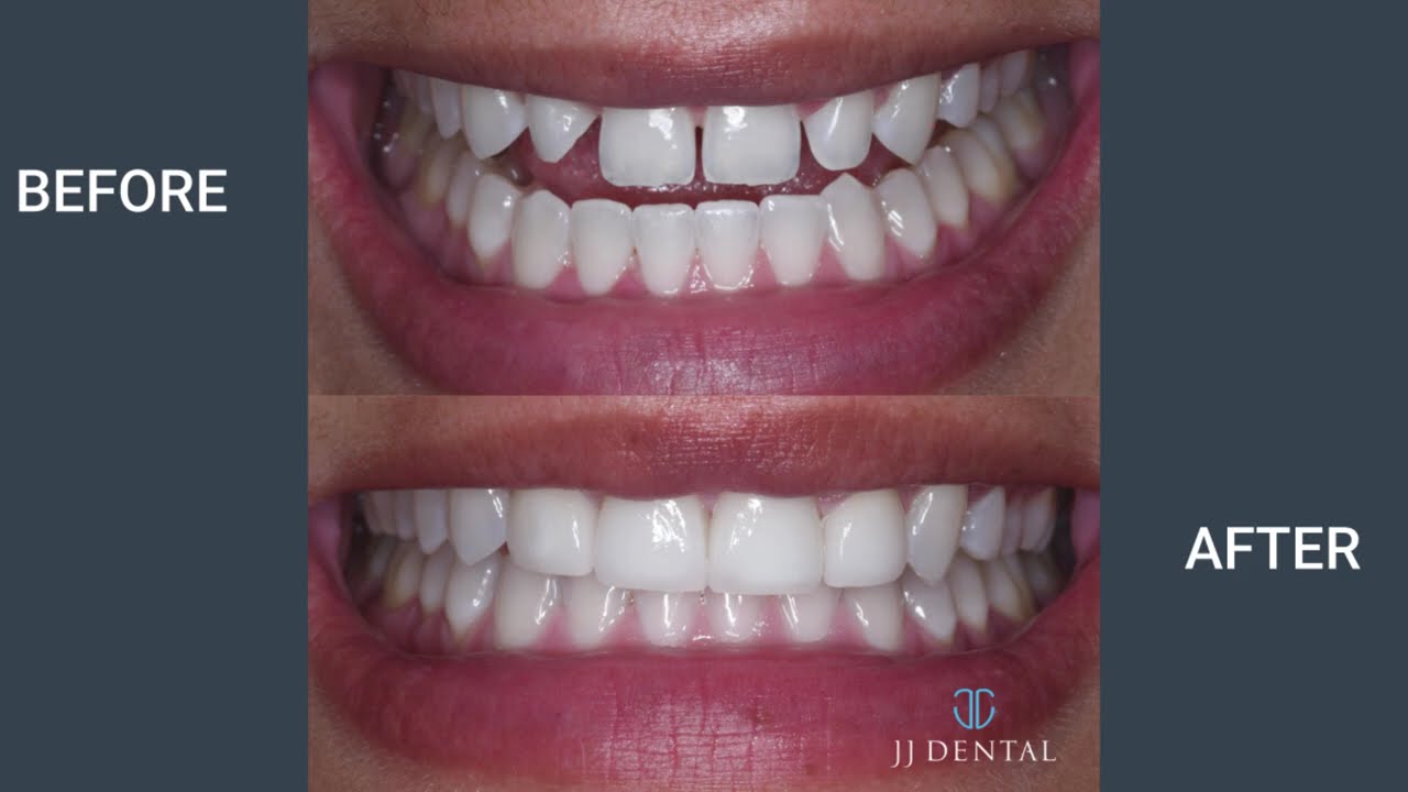 Smile Makeovers by the Best Dentists in Fort Lauderdale