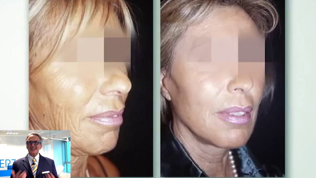 Dott. Santanchè: età consigliata per il lifting chirurgico viso