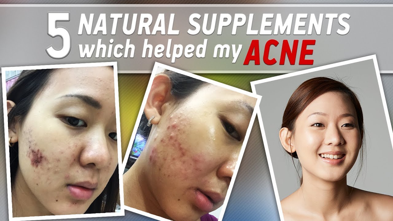 How I Fight ACNE with Natural Supplements (before & after) | Joanna Soh