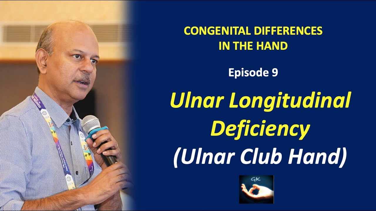 Congenital hand differences: Episode 9 - Ulnar Longitudinal Deficiency or Ulnar Club hand
