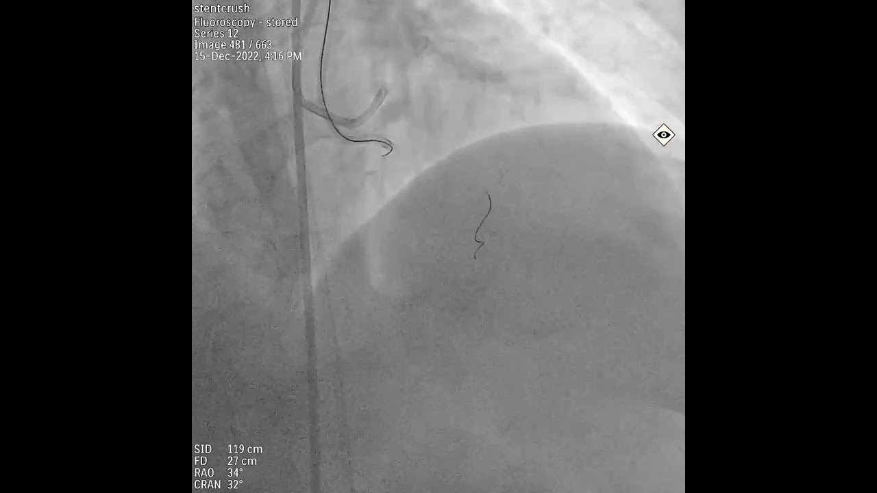 Retrograde approach to RCA CTO