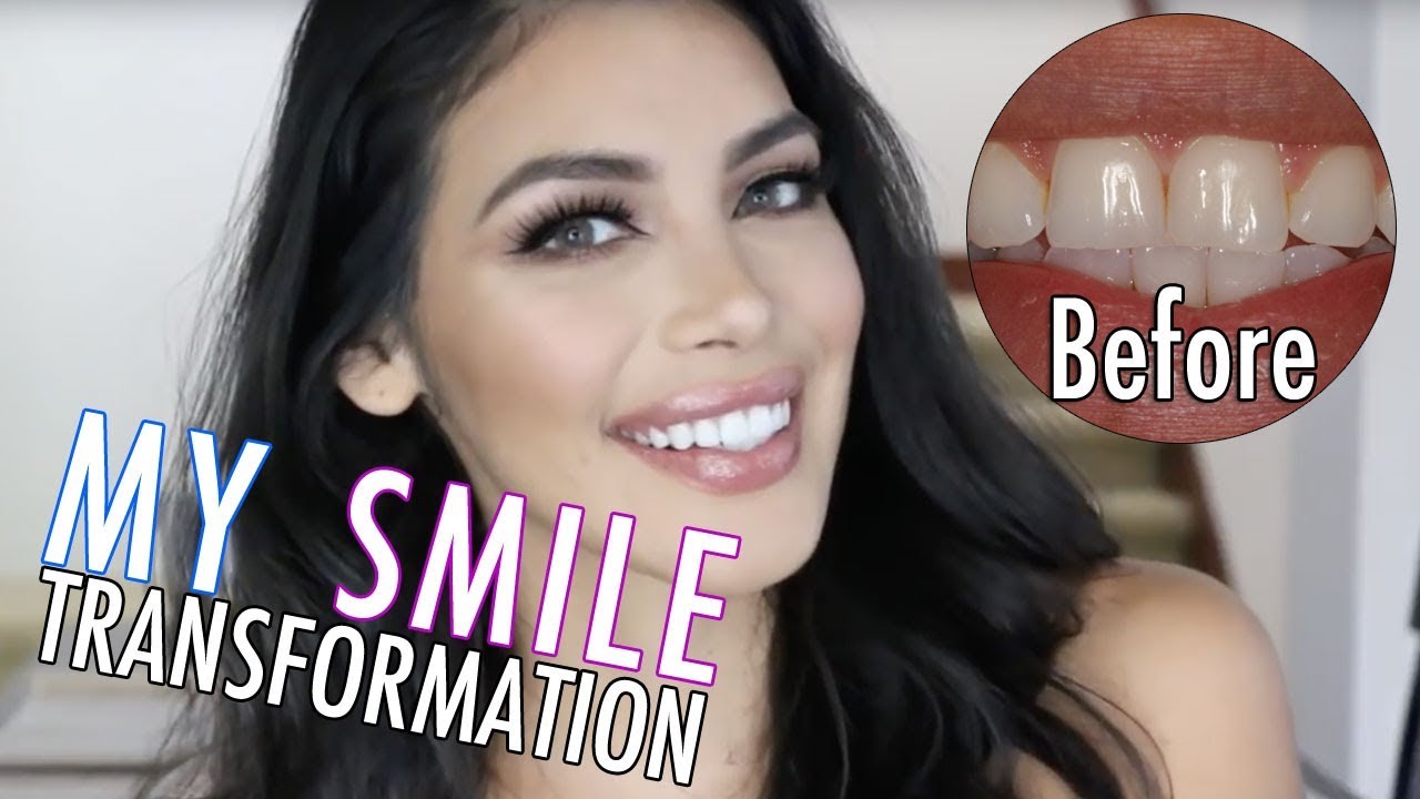 Porcelain Veneer Experience, Before and After Southland Dental Care Sherman Oaks Los Angeles