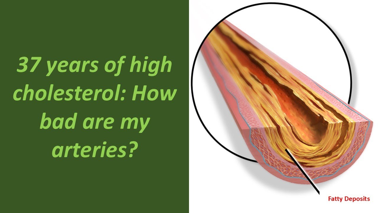 37 Years of High Cholesterol: How Bad are My Arteries?