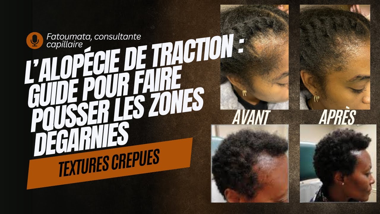 Alopécie de traction : Comment faire pousser les zones dégarnies ? Comment prévenir l'alopécie ?