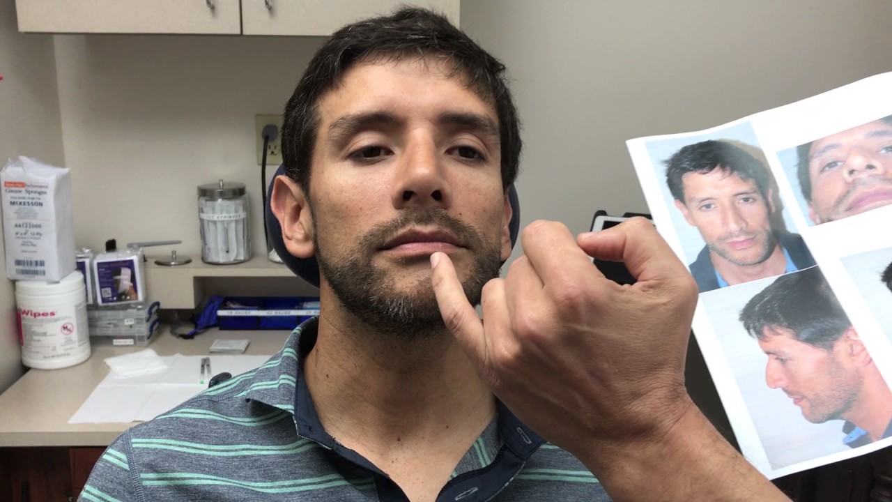 Male Rhinoplasty - Correcting the Twisted Nose | Dr. Jeffrey Epstein