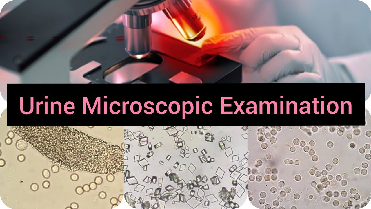 Urine Microscopic Examination | Puscell |RBCs |Cast, Crystals |Urine Test ||
