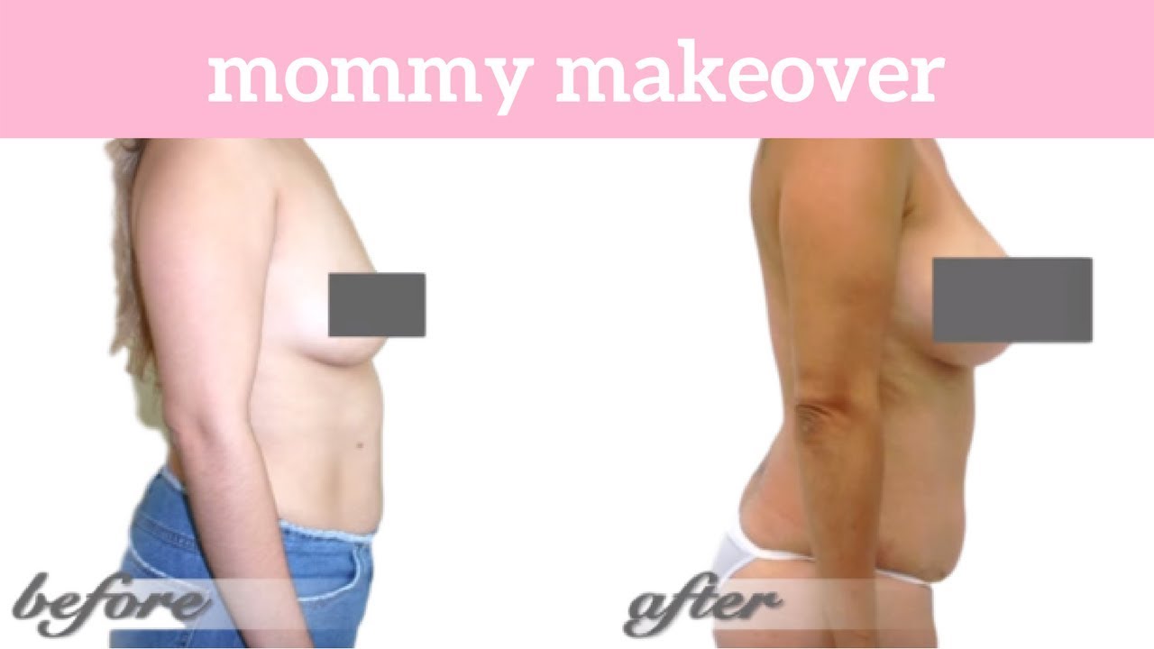 Carmen Visits Lift MD Aesthetics for a Mommy Makeover