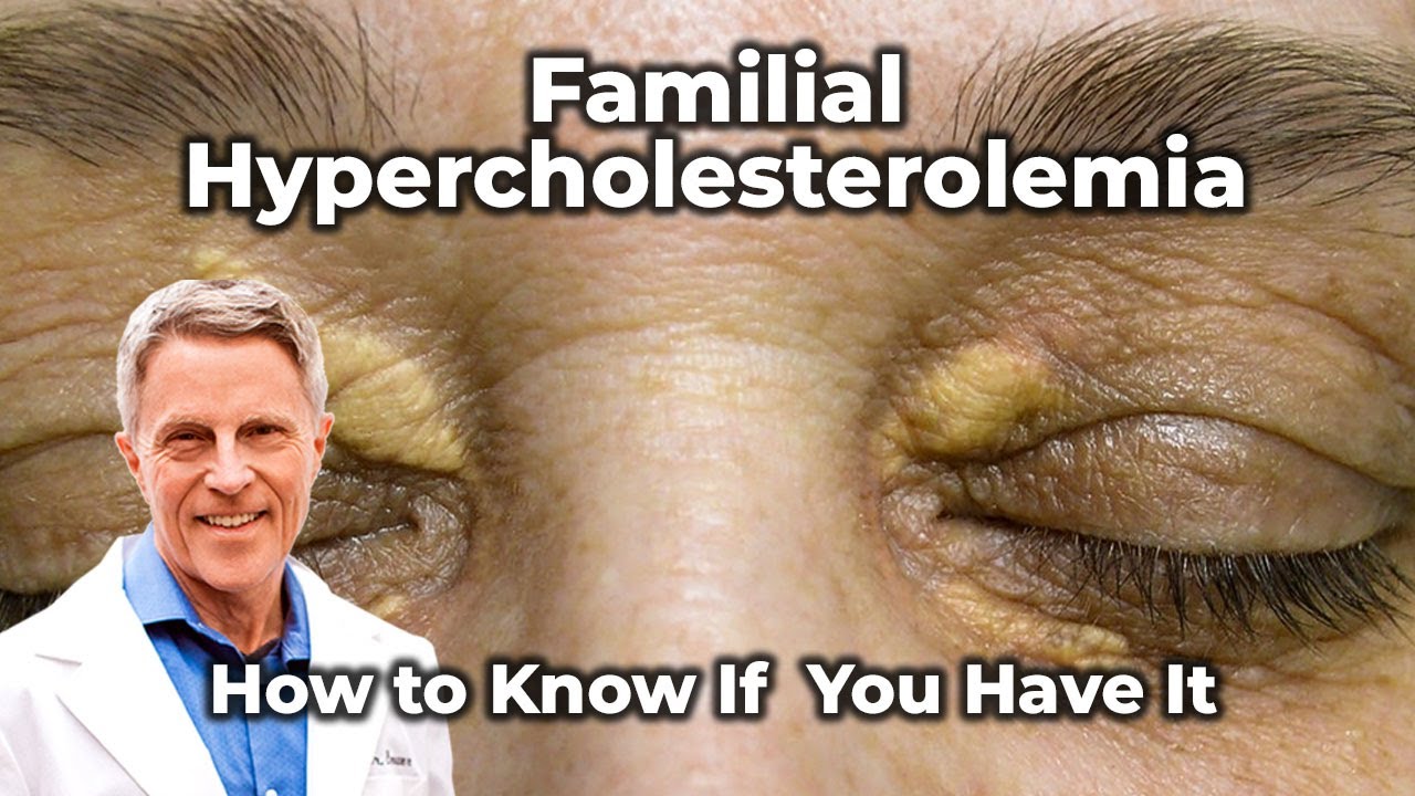 Familial Hypercholesterolemia - How to Know If You Have It