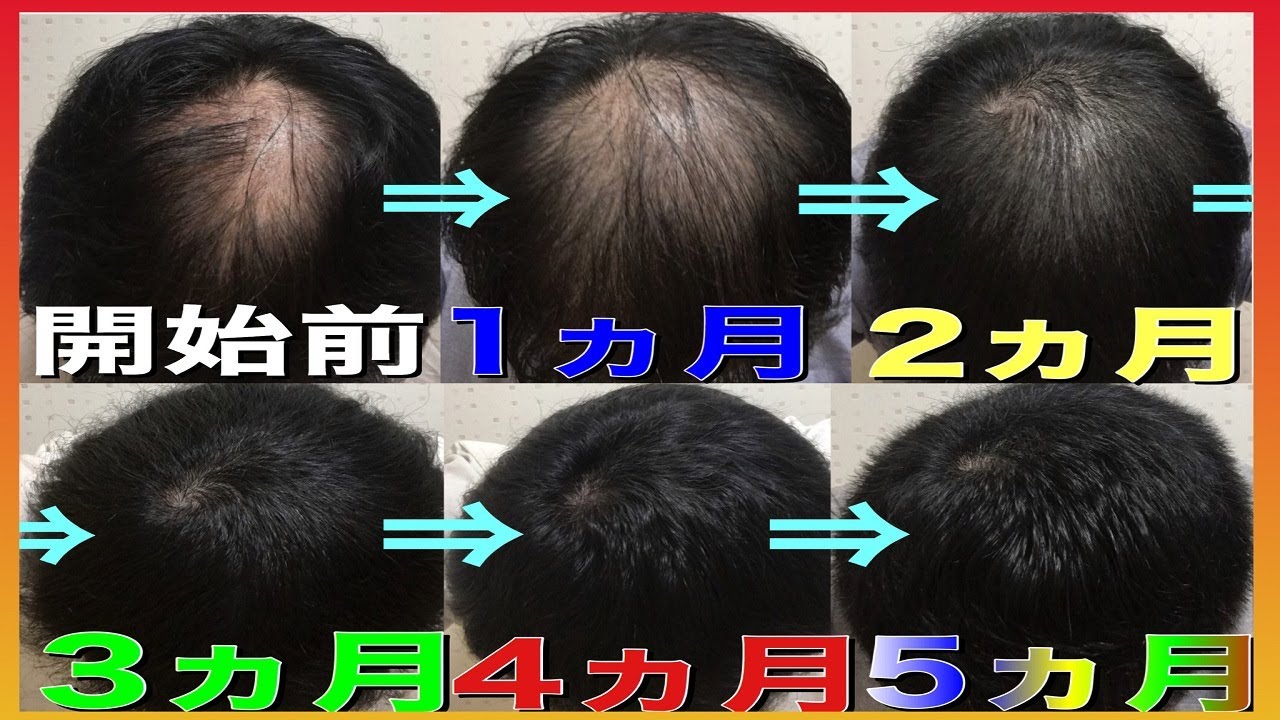 【AGA治療】つむじハゲが改善するまでを徹底解説【ハゲは治る時代です】