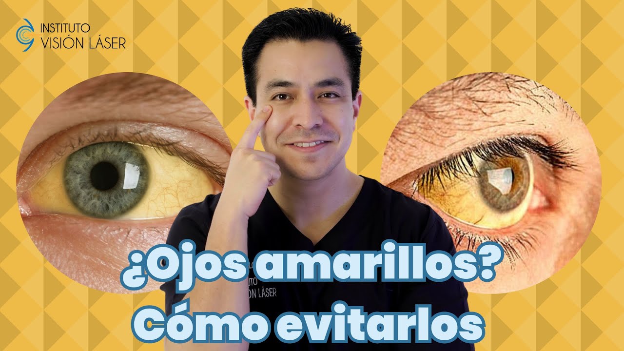 Ojos amarillos ¿Cómo evitarlos?