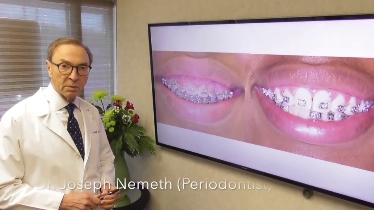 Your Braces Could Be Causing Gum Problems