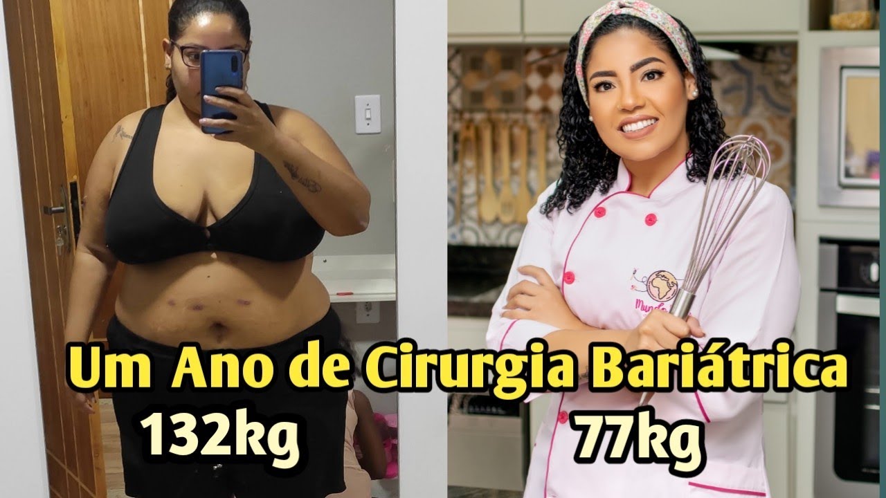 1 Ano de Cirurgia Bariátrica