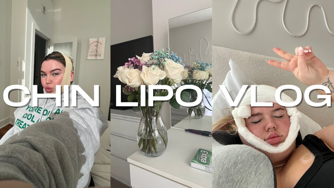CHIN LIPO VLOG | my experience, recovery, cost, etc.