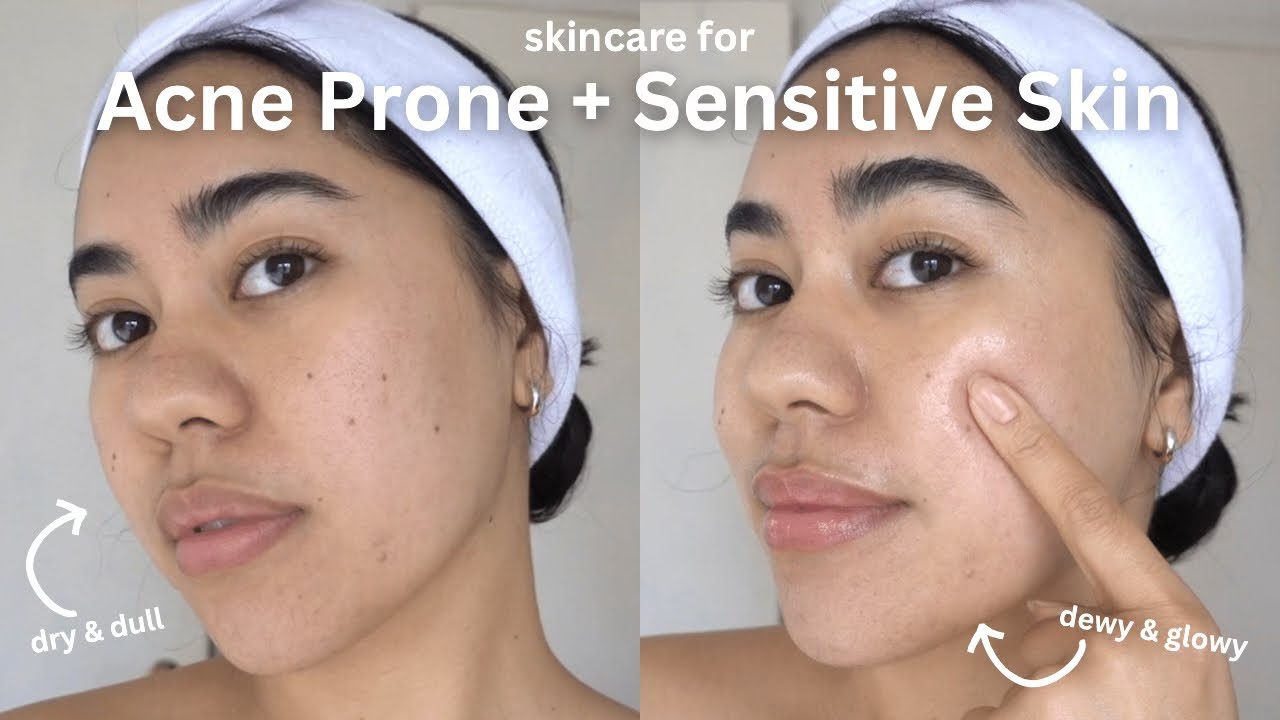 Acne Prone + Sensitive Skincare 🌿 (glowy skin and acne fighting)