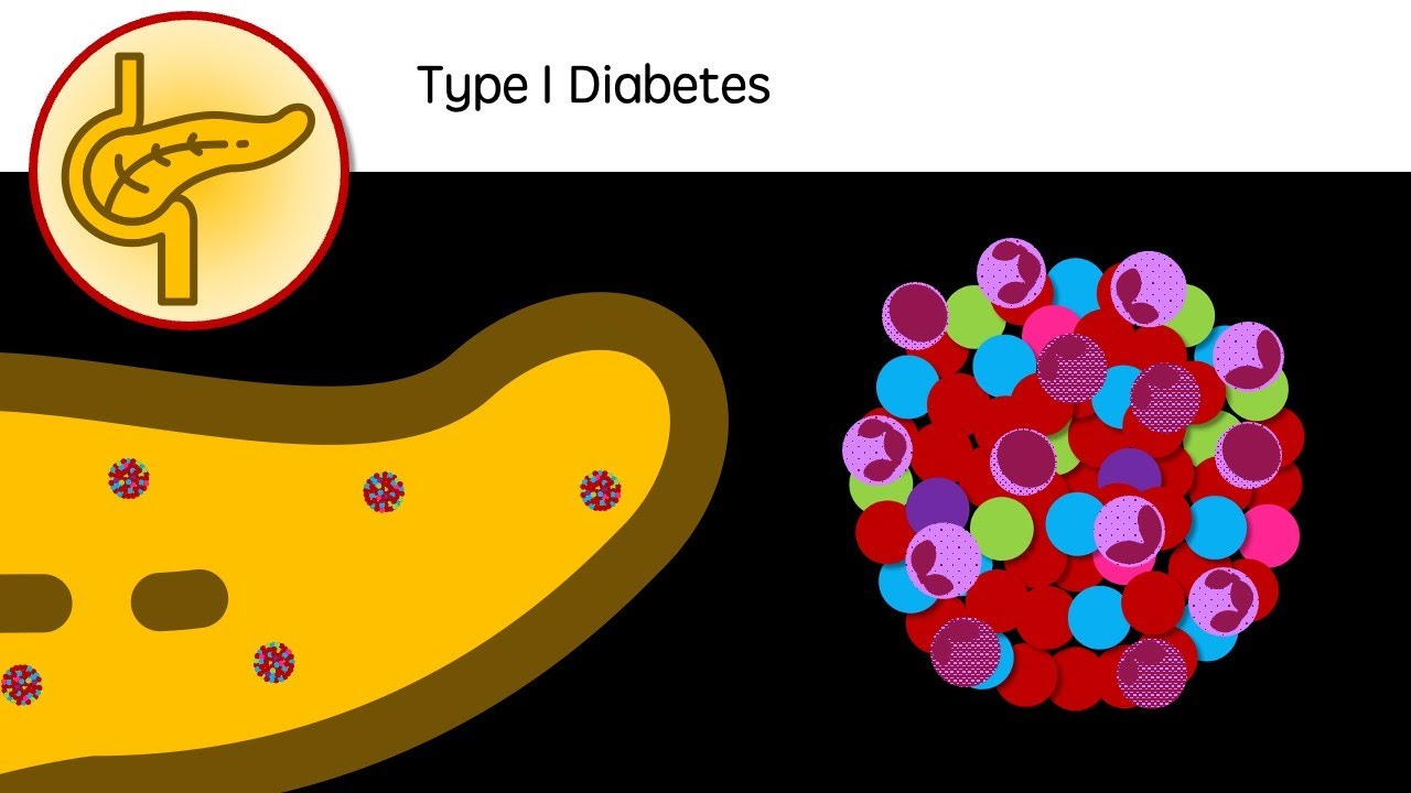Type I Diabetes