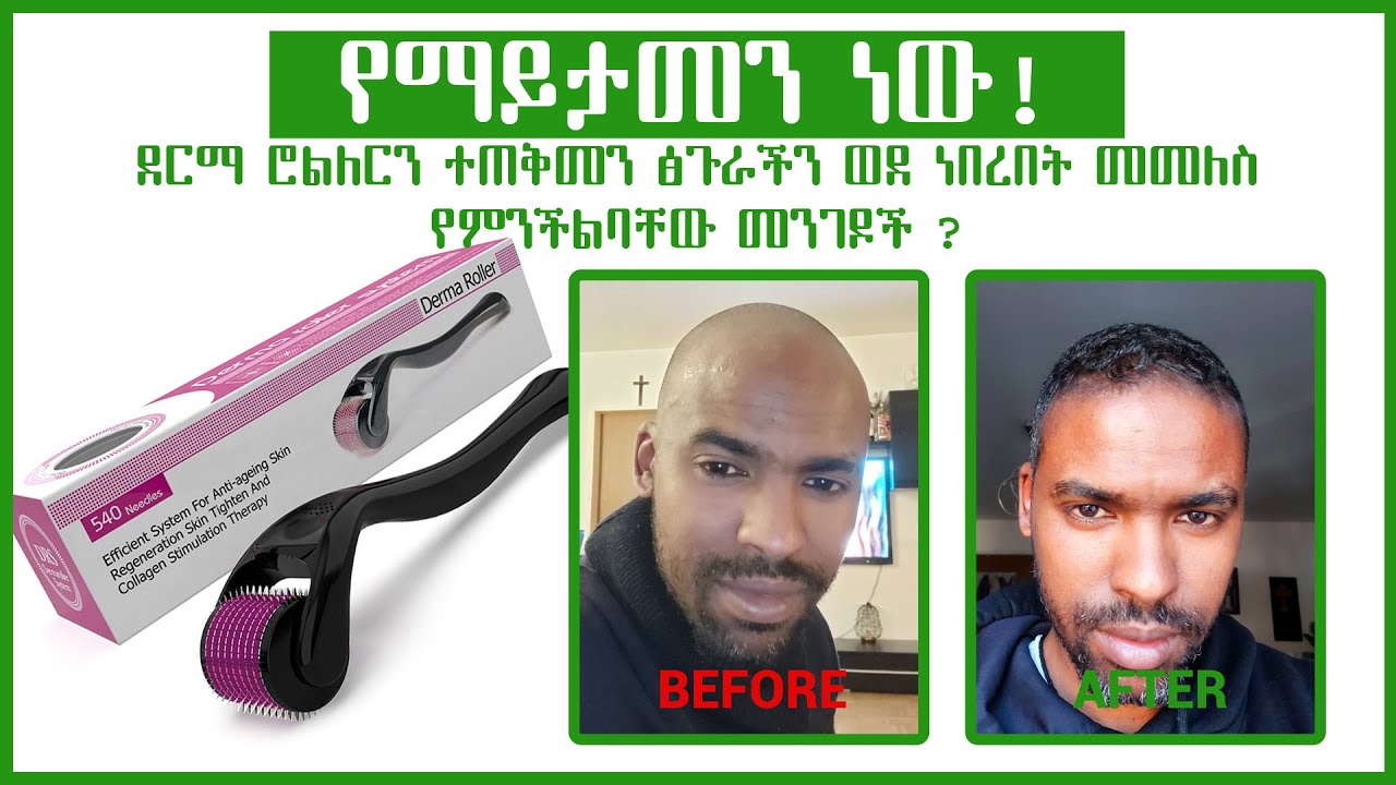 Derma Roller, የማይታመን ደርማ ሮልለርን ተጠቅመን ፅጉራችን ወደ ነበረበት መመለስ የምንችልባቸው መንገዶች
