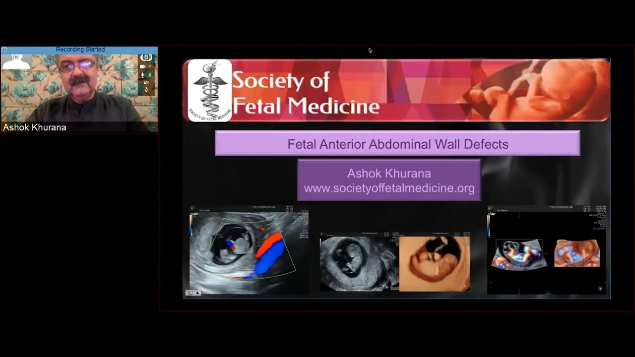 GE Webinar: Ultrasound Imaging - Fetal Anterior Abdominal Wall Defects by Dr. Ashok Khurana