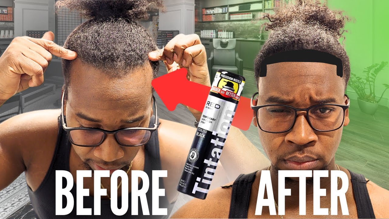 PERMANENTLY FIXING RECEDING HAIRLINE || DIY
