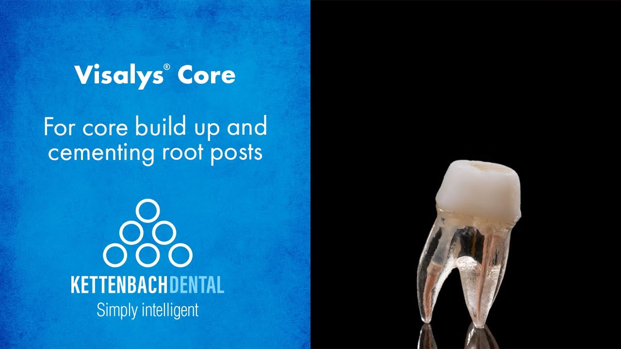 So stable is Visalys® Core  - for core build up and cementing root posts.
