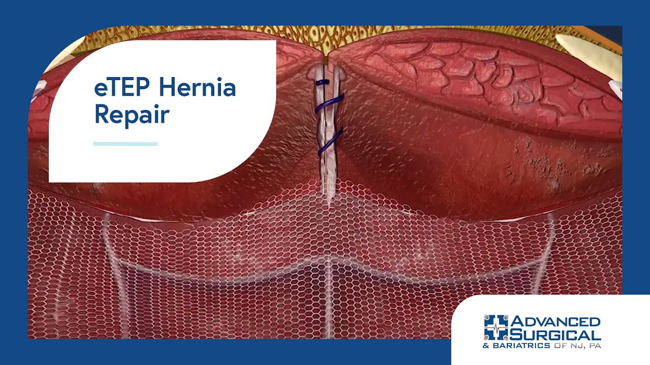 eTEP Hernia Repair