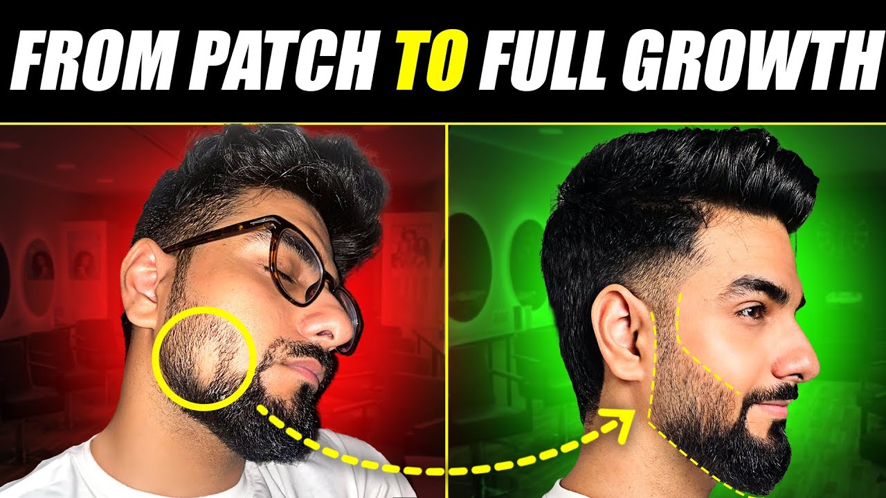 This is How I Treated a DANGEROUS Beard Patch? 😰 Alopecia Areata Treatment | The Gabru Life