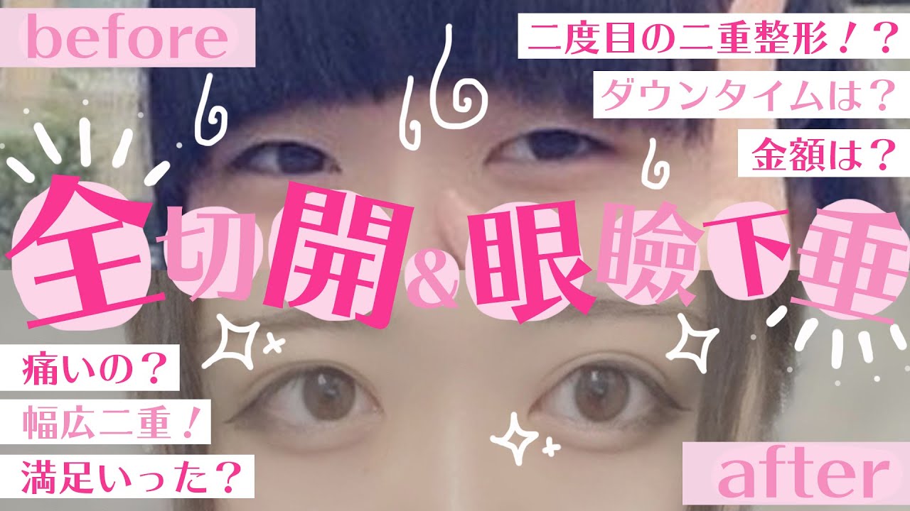 【二重整形】理想の二重幅になれる！？全切開&眼瞼下垂ってどうなの？？【眼瞼下垂】