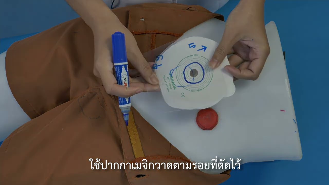 a01การเปลี่ยนถุงรองรับหน้าท้องแบบตัวล็อค