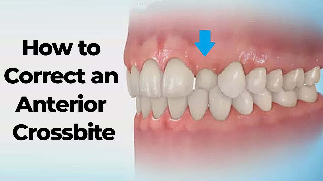 How to Correct an Anterior Crossbite, Finger Spring 