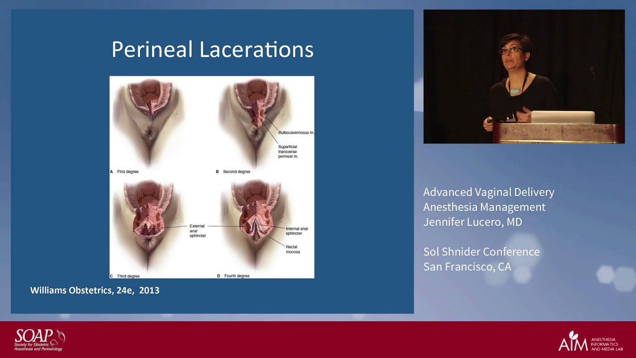 Advanced Vaginal Delivery Anesthesia Management Jennifer Lucero, M.D.