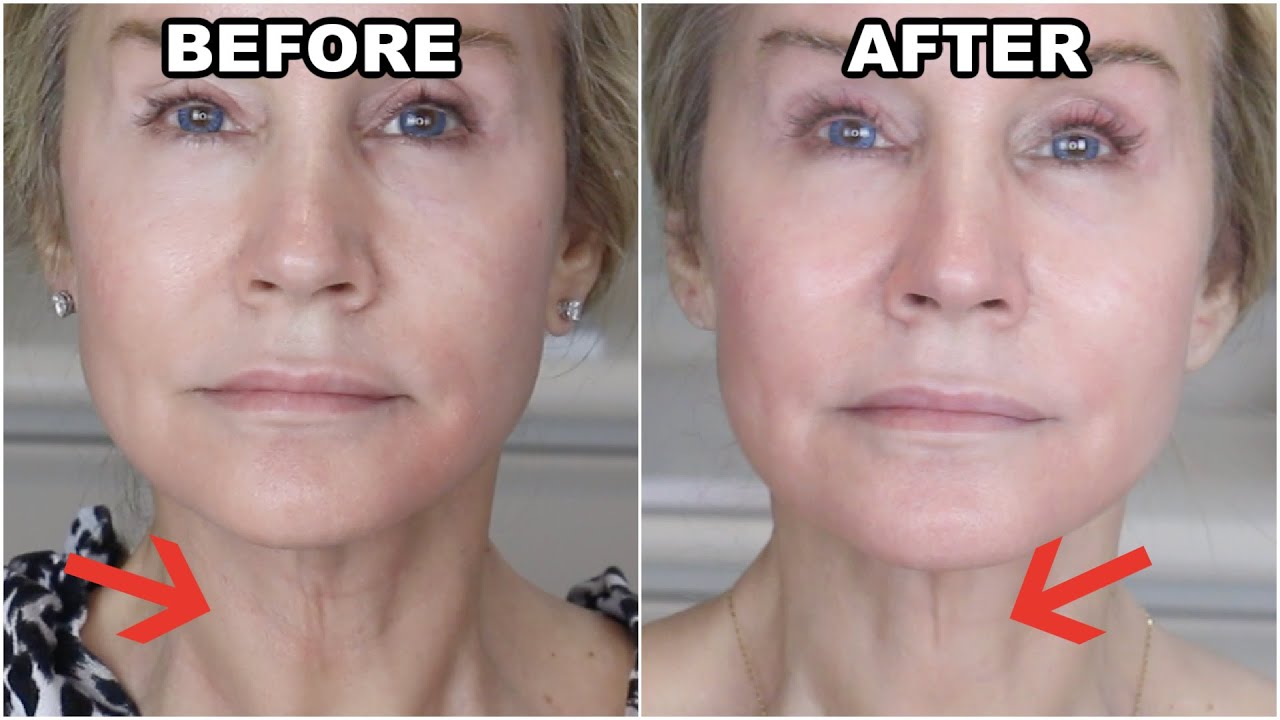 ЛЕЧЕНИЕ МОРЩИН НА ШЕЕ В ДОМАШНИХ УСЛОВИЯХ? | БЕЗ ХИРУРГИИ И ФИЛЛЕРОВ!