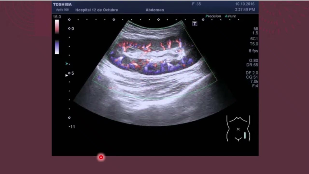 Valoración Doppler del injerto renal. Ecografía del trasplante renal.  Parte I