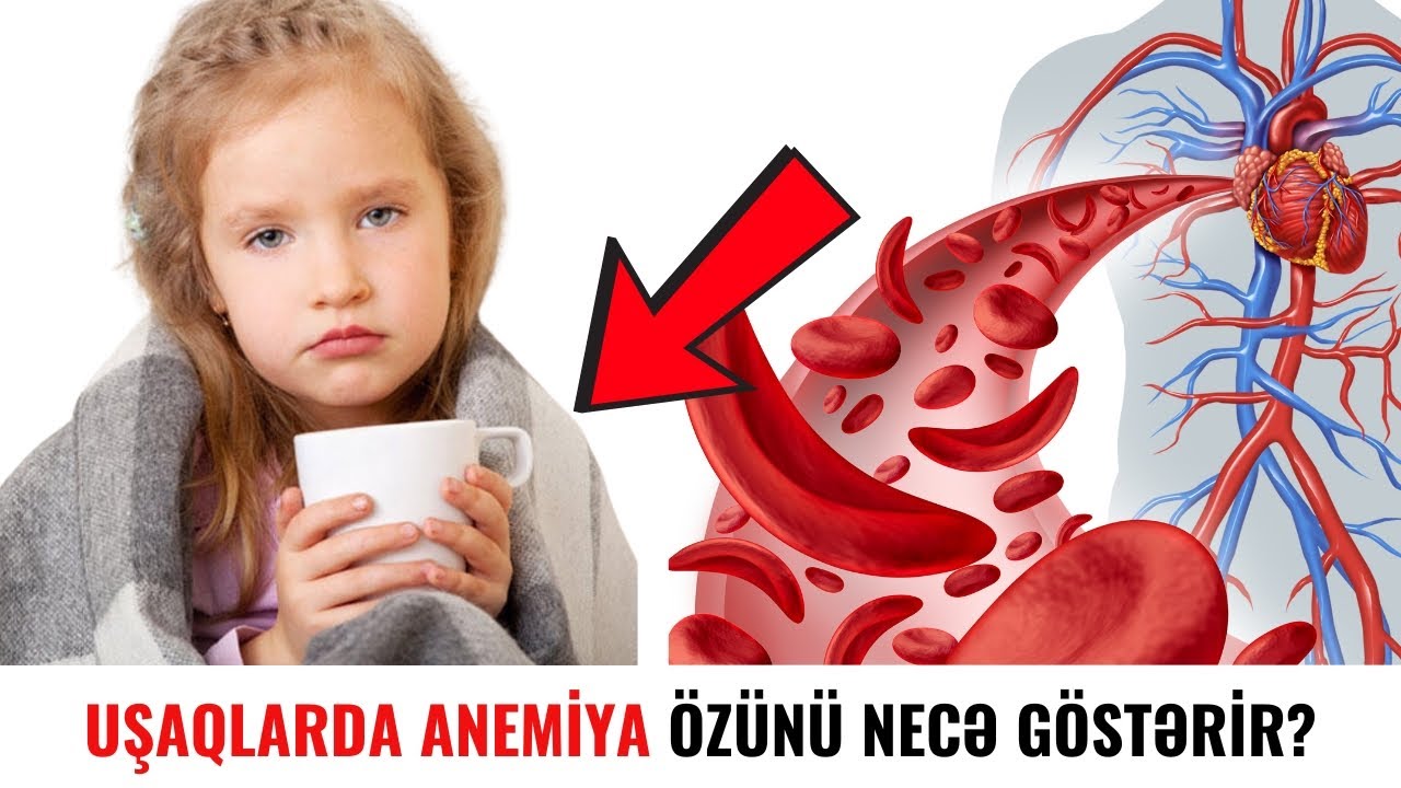 Uşaqlarda anemiya (qanazlığı) problemi necə aşkarlanır?