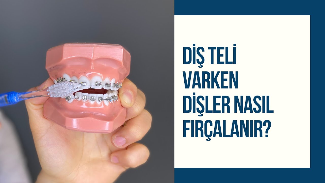 Diş teli varken dişler nasıl fırçalanır? |  Ortodontik tedavide ağız bakımı nasıl olmalı?