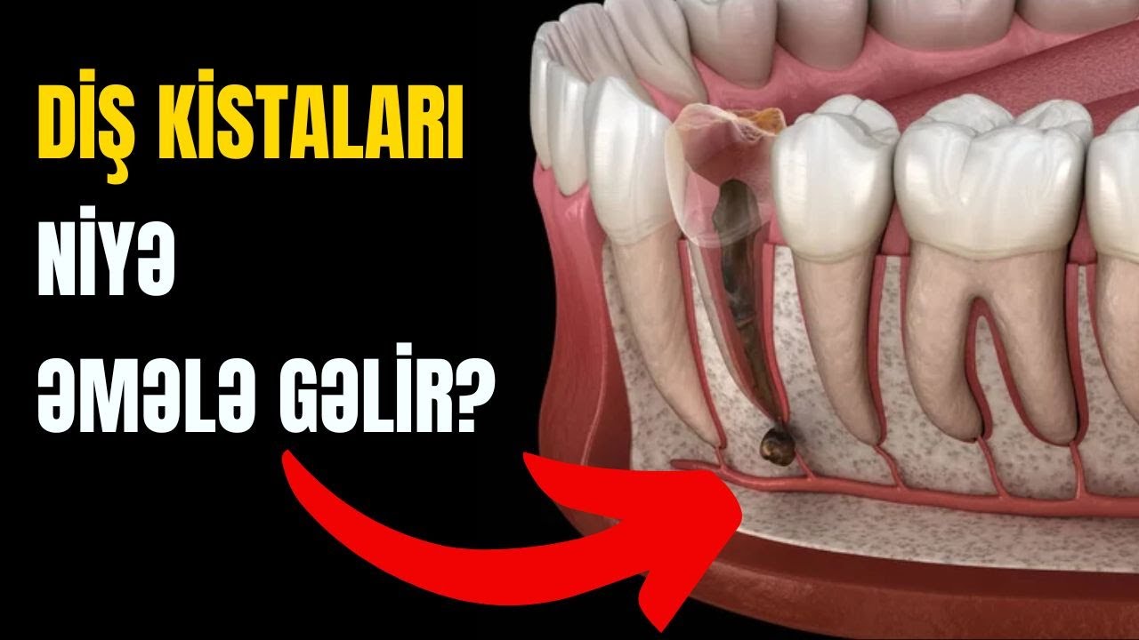 DİŞ KİSTASI - Müalicəsi varmı?