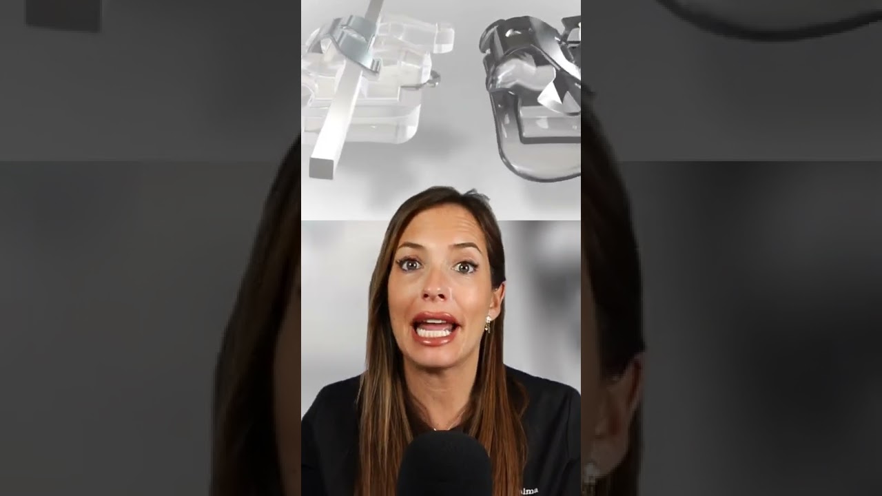 &iquest;Existen BRACKETS SIN LIGAS? Te explico c&oacute;mo funcionan los BRACKETS de AUTOLIGADO