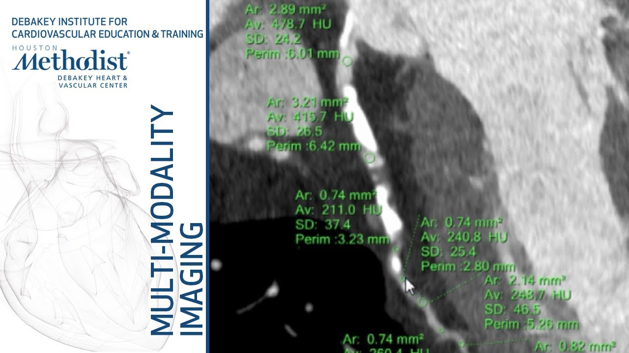 Coronary Imaging with CTA: Methodology, Advantages and Pitfalls (Su Min Chang, MD) November 6, 2018