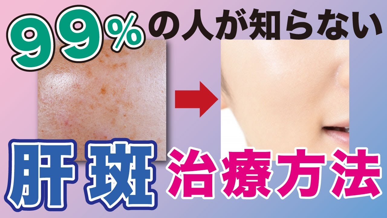 【肝斑治療】99%の人が知らない肝斑の治療方法とは？【シミ治療】