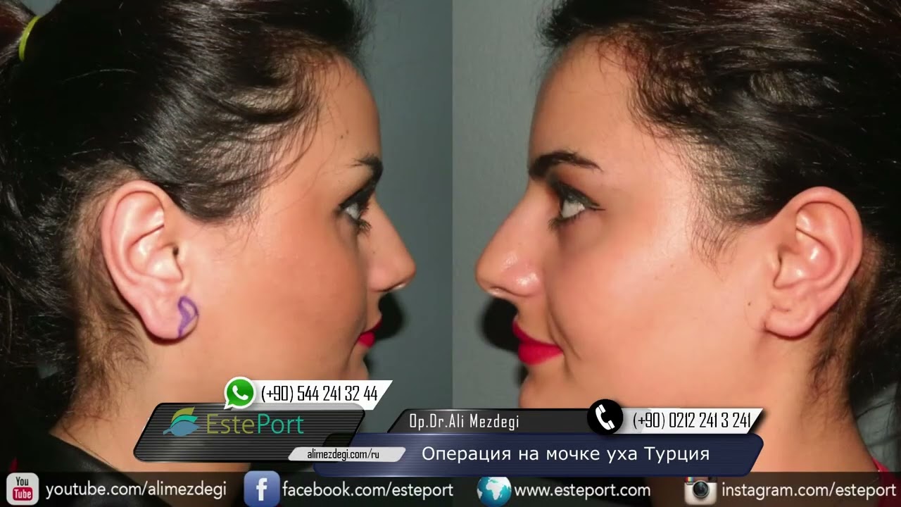 Операция на мочке уха Турция