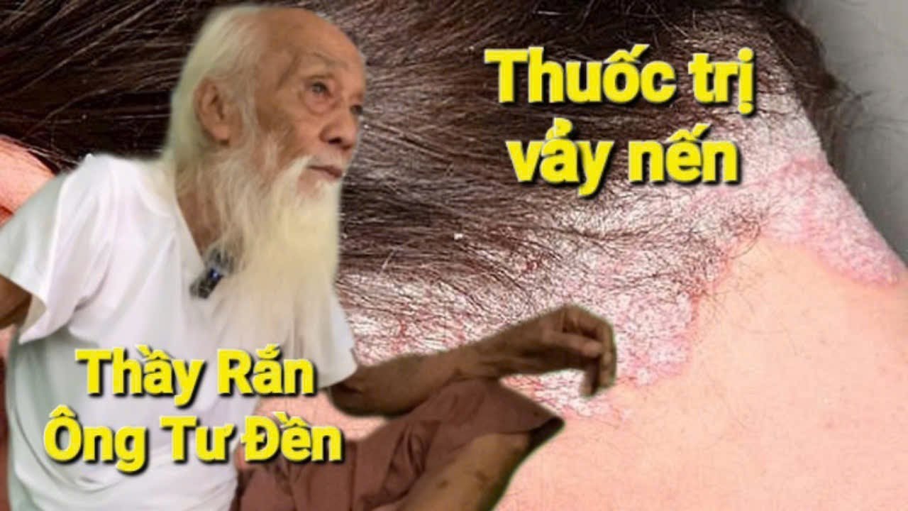 Thầy Rắn (Ông Tư Đền)bất ngờ Ông Tư cho bài thuốc vảy nến đến Ông Tư chữa trị