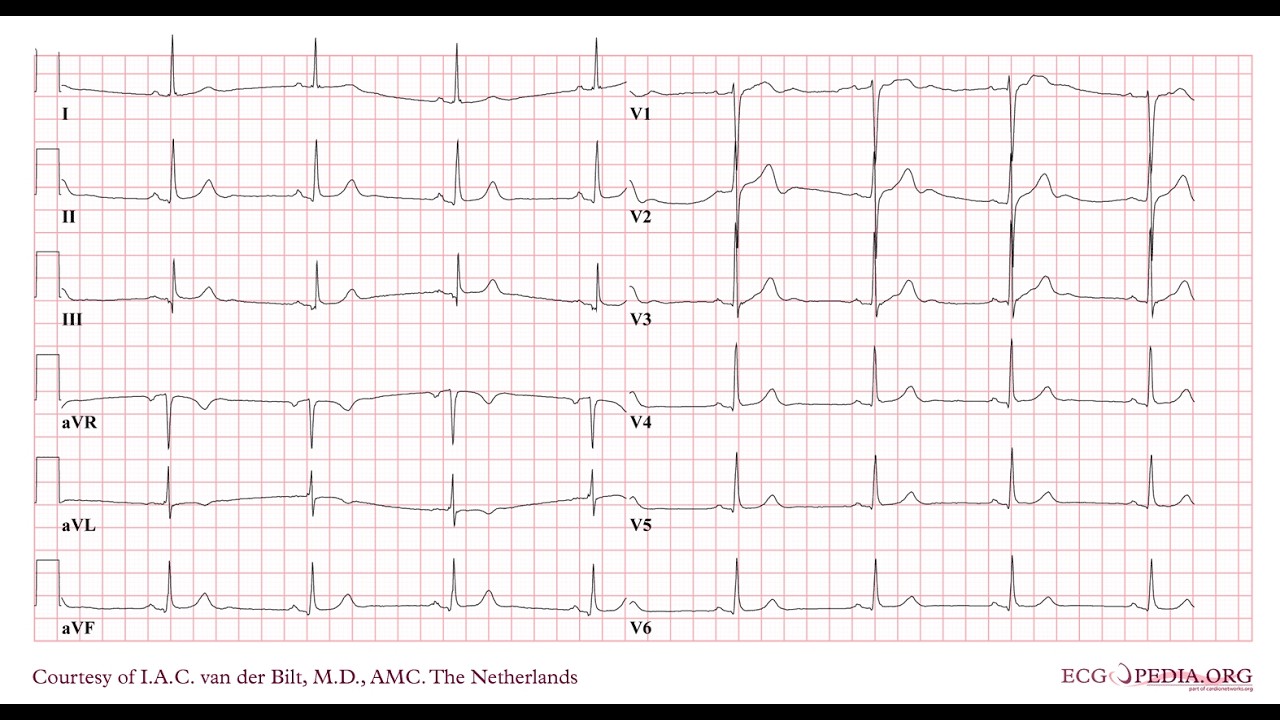 Pulsless Electrical Activity USMLE/Pediatrics Boards