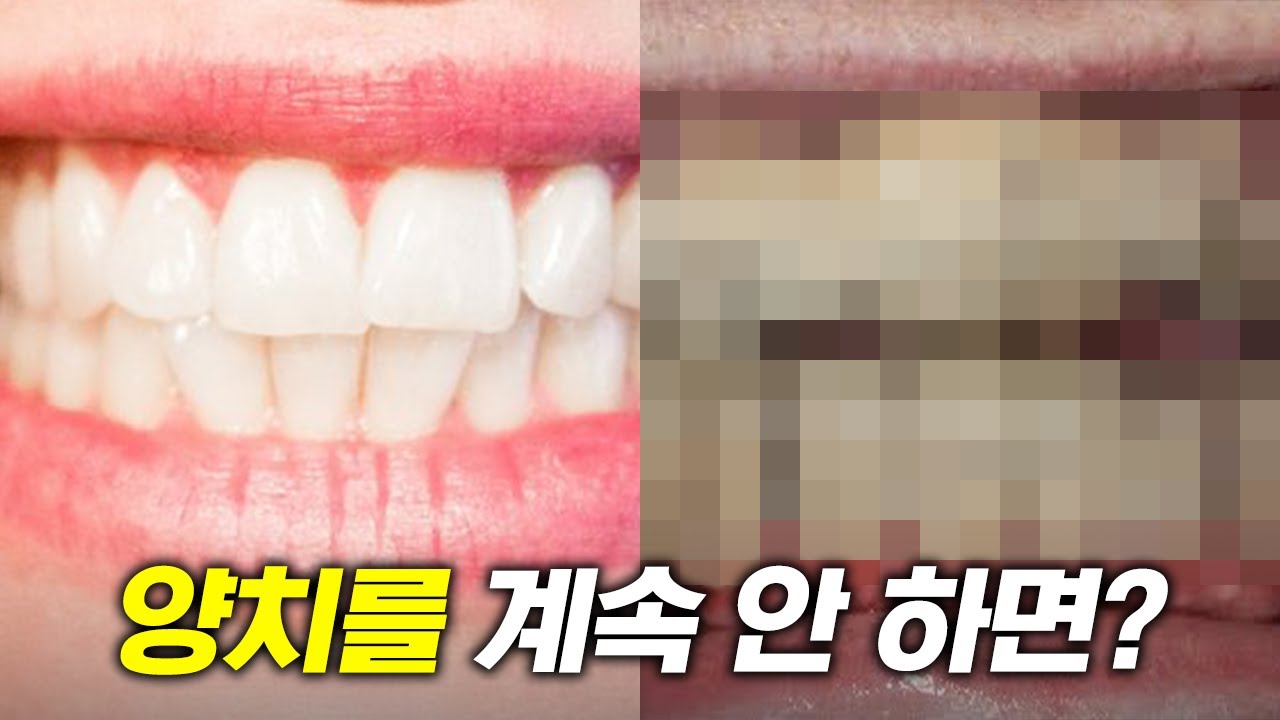 (극혐주의) 양치를 안 하면 어떻게 될까?