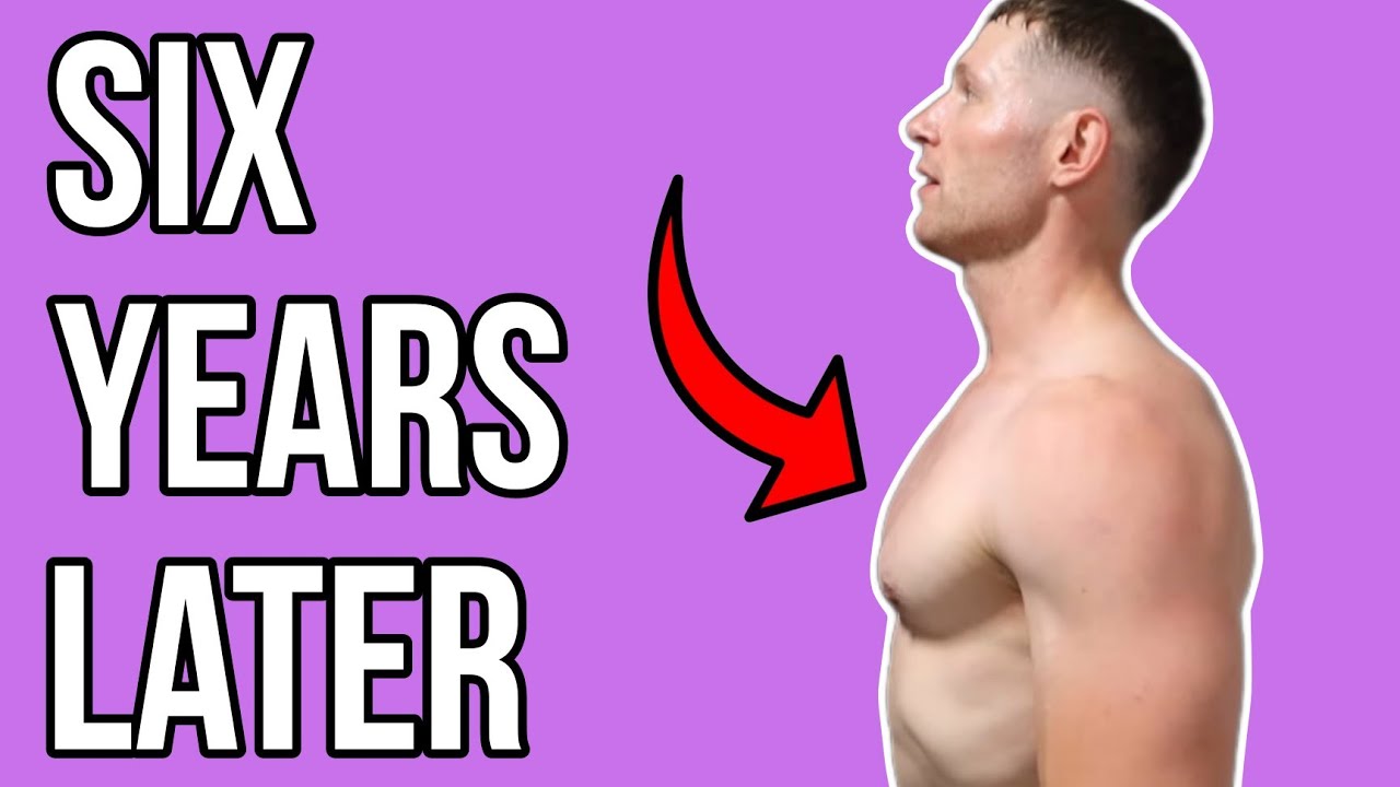 6 Years After Having Gynecomastia Surgery | How Does It Look & Feel? (WITH A PUMP)