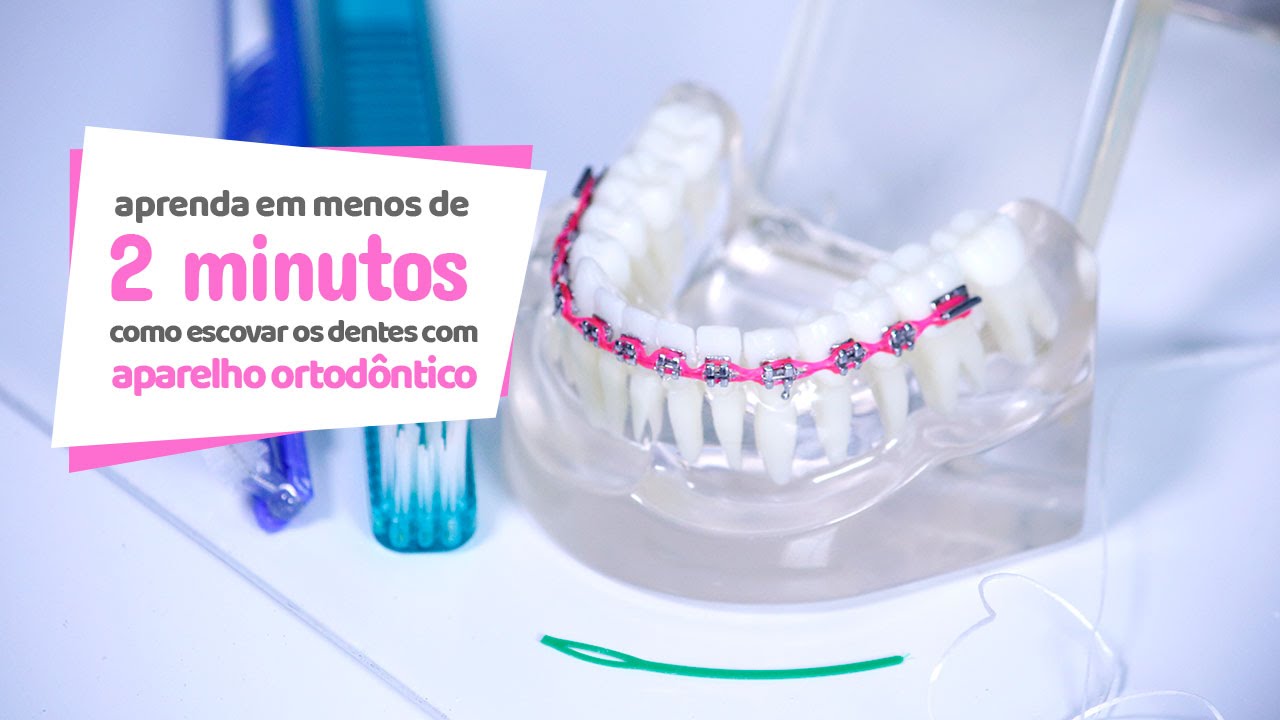 Como escovar corretamente os dentes com aparelho ortodôntico - Cir Hospital Odontológico